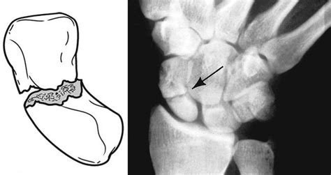 Scaphoid Fracture of the Wrist - OrthoInfo - AAOS