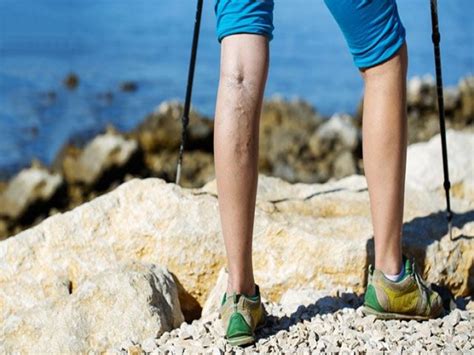 The best exercises to get rid of Varicose Veins | Comprehensive Vein Care