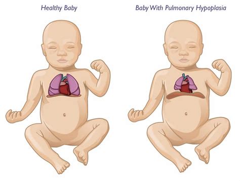 Pulmonary hypoplasia causes, symptoms, diagnosis, treatment & prognosis