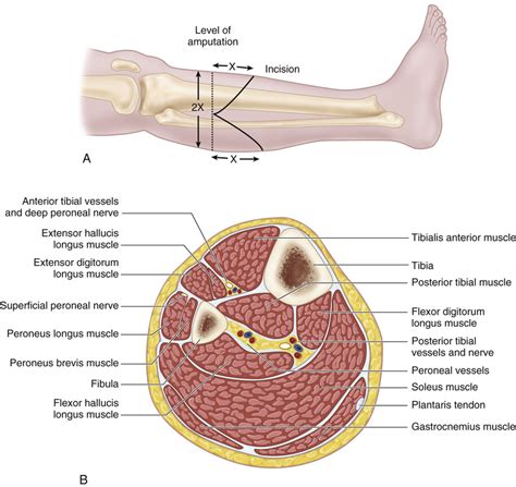 57 Below-Knee Amputation | Musculoskeletal Key