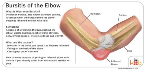 Elbow Bursitis | Bursitis elbow, Bursitis, Bursitis treatment