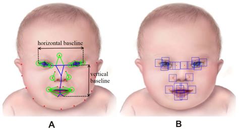 Down Syndrome Face Features Clipart