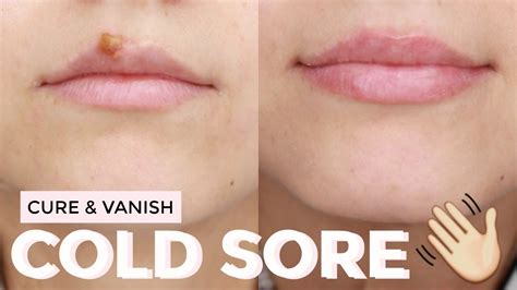 How To Cover A Cold Sore Scab With Makeup - Mugeek Vidalondon