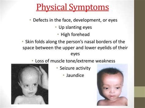 Zellweger syndrome | PPT