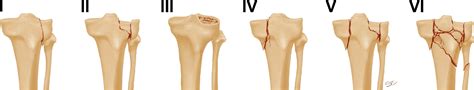 Revisiting the Schatzker classification of tibial plateau fractures ...