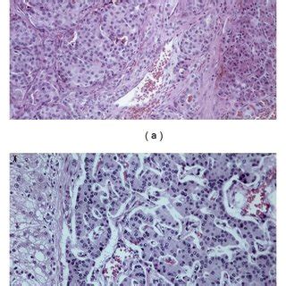 (a) Microscopic features of the excised insulinoma.... | Download ...