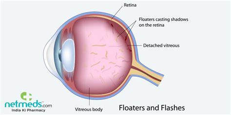 Eye Floaters: Causes, Symptoms And Treatment