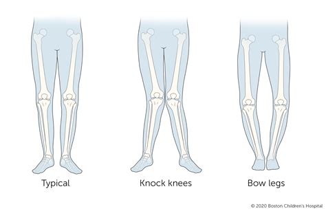 Walking (Gait) Abnormalities | Boston Children's Hospital