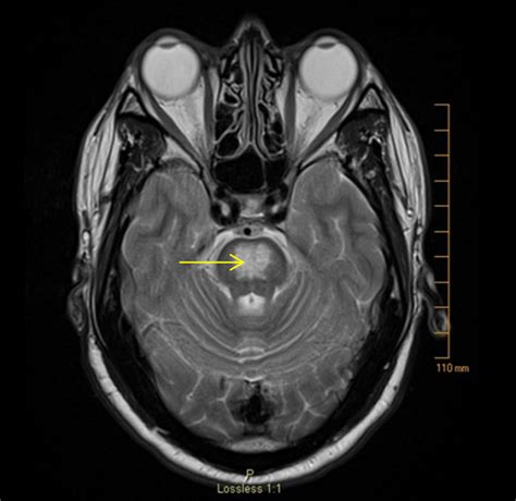 MRI brain T2 image demonstrating a symmetric hyperintense lesion in the... | Download Scientific ...