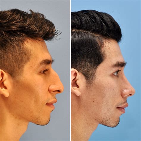 Top Rhinoplasty Surgeons In Nyc - Midland News Update