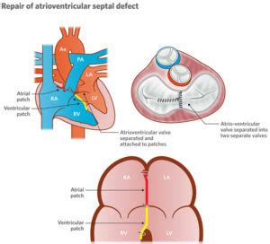 Atrioventricular canal defect causes, symptoms, diagnosis, treatment & prognosis