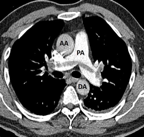 Saddle pulmonary embolism – Radiology Cases