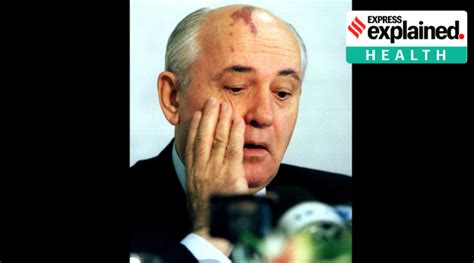 Port wine stain: that large red mark on Mikhail Gorbachev’s forehead ...