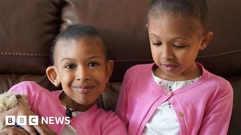 Conjoined twins meet surgeons who separated them - dailyOnews