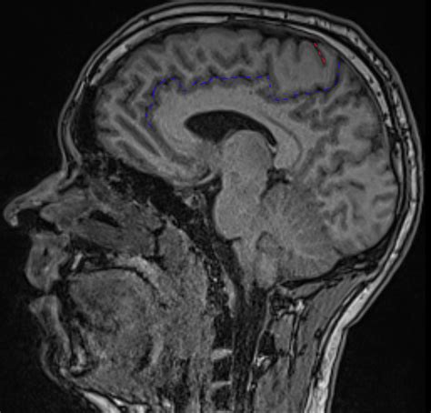 Sulcus cinguli - Ars Neurochirurgica