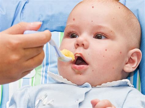 Food Allergy Symptoms in Babies and Children | Parenting How