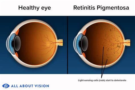 People With Retinitis Pigmentosa