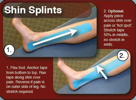 posterior shin splints taping - Google Search | Shin splints ...