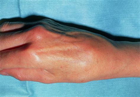 Swollen Right Hand Due To Osteoarthritis In Wrist Photograph by Medical ...