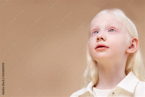 Albino. Cute caucasian little girl with albinism syndrome, she looks up ...