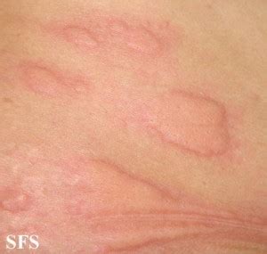 Drug Reaction Skin Rash and Medication Causing Skin Eruptions | Healthhype.com