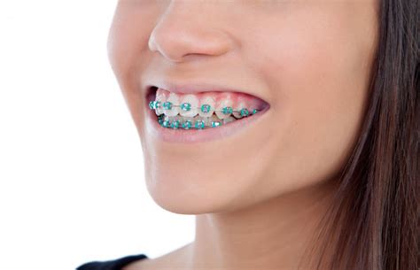 Orthodontics Braces - How To Prevent Cavities With Braces