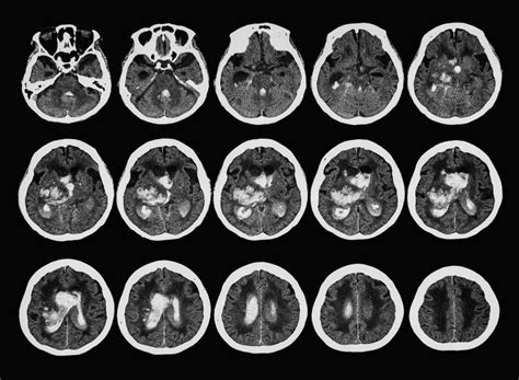 The role of CT and MR in stroke patients