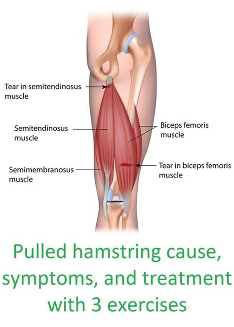 Pulled hamstring cause and treatment with 3 exercises