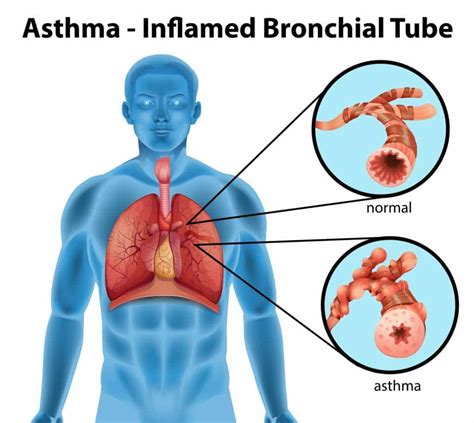 What Organs Are Affected By Asthma - KnowYourAsthma.com