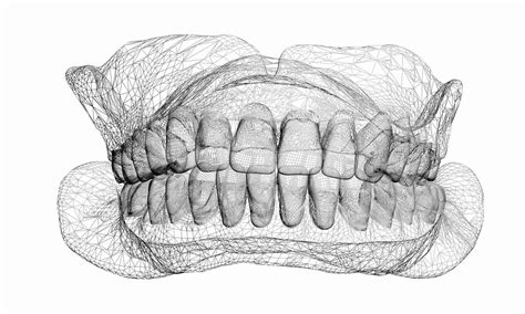 Dental Splinting – Lane Ends Dental Practice – Preston