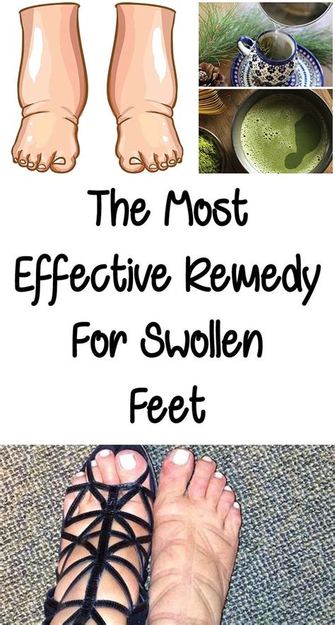 Pin on Swollen feet remedies