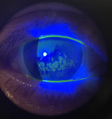 Coalesced superficial punctate keratitis : r/optometry