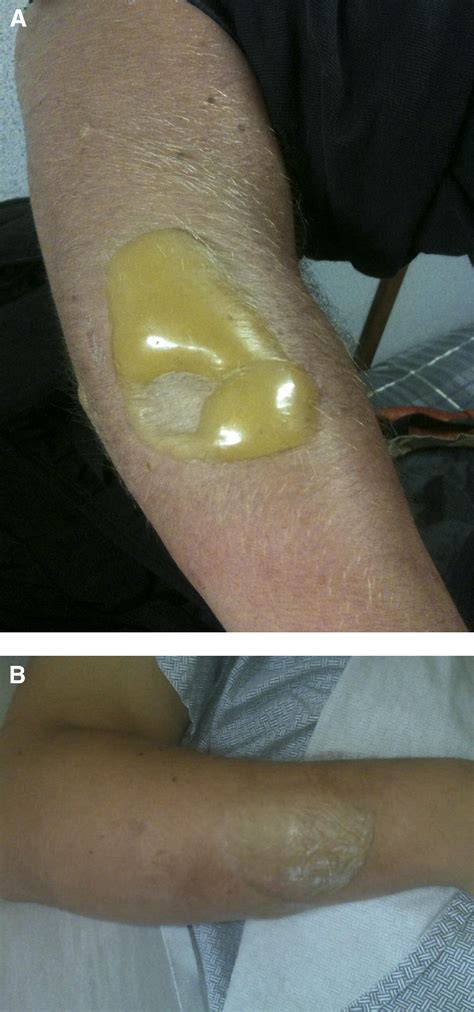 Sulfur Mustard Exposure Presenting to a Community Emergency Department - Annals of Emergency ...