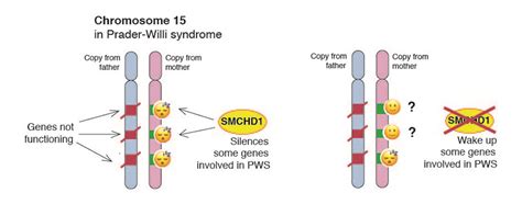 Waking 'sleeping genes' could help Prader-Willi syndrome