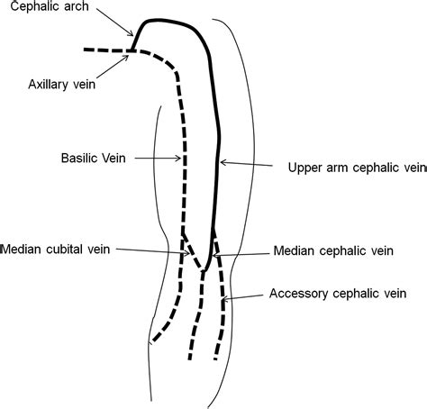 References in Clinical Significance of Upper-arm Cephalic Vein Patency ...