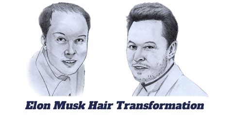 How Elon Musk Restored His Hair - Kiierr Hair Growth Experts