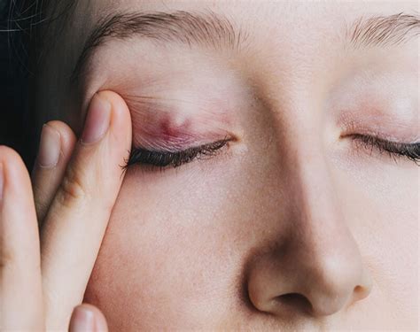 Chalazion: All your questions answered! - Oculase