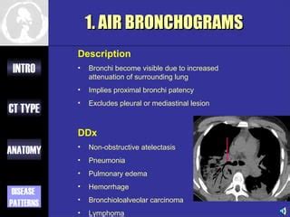 Approach to ct chest 578 | PPT