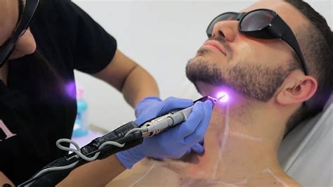 Laser Hair Removal for Men NYC - Laser Services LaserWorks