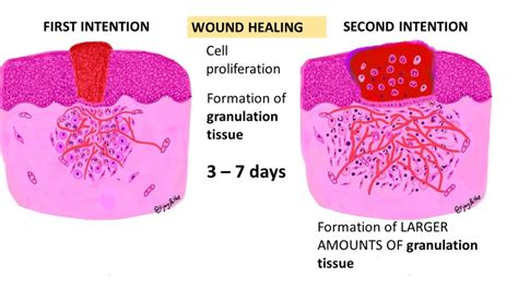 TISSUE REPAIR: Wound Healing - Pathology Made Simple