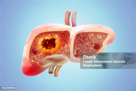 Liver Cancer Or Liver Tumor Hepatocellular Carcinoma Causes Symptoms ...