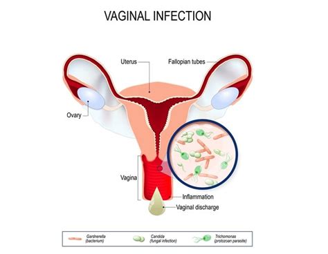 Vaginitis Patofisiologi Diagnosis Penatalaksanaan Alomedika | The Best Porn Website