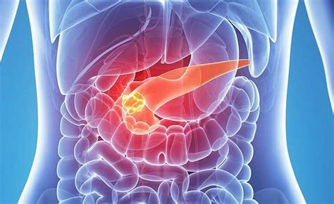 5 Key Facts about Pancreatic Neuroendocrine Tumors - Pancreatic Cancer Action Network