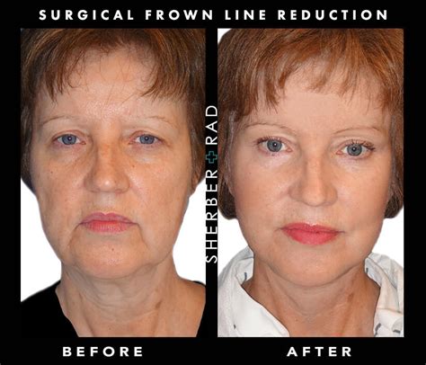 Frown Line Reduction Washington DC | Northern VA