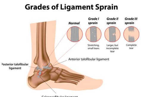 Rolled ankle treatment and physiotherapy. Optimise Physio Sydney.