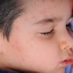 Mumps Symptoms in Children | Signs and Treatment of Babies