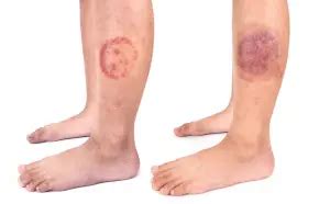 Difference Between Nummular Eczema and Ringworm - Our Eczema - Dedicated to Helping Eczema ...