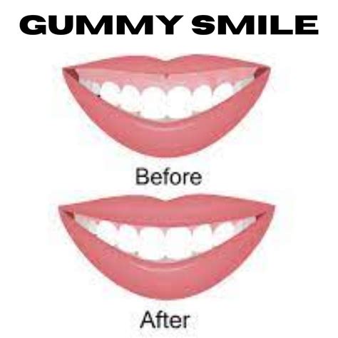 Gummy Smile: What Causes It & How is It Treated? - D. Dental