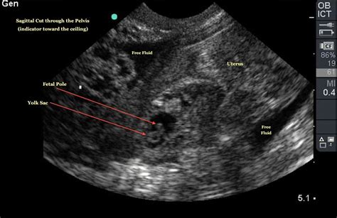 Pin on OB/Gyn Ultrasound 101 Mod 2