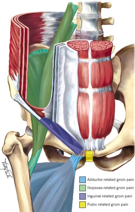 Defined clinical entities for groin pain.Adductor-relat | Open-i